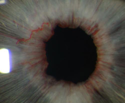 eyedefects:  Extensive iris neovascularization