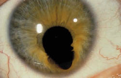 bbllacckk:  Inferonasal colobomatous defect