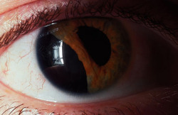 eyedefects:  Traumatic iridodialysis. The