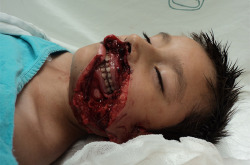 missjessicahoangkim:  musingsofasomebody:  someasian:  carldevera:  ihavespokenn:  Mexico’s first face transplant was successful. 7 year old, Raul Carrizales Jaramillo was mauled by a pitbull and his face was extremely damaged but now is recovering