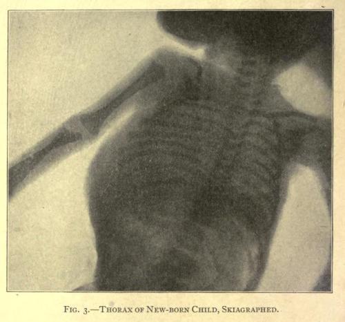 Thoracic x-ray of newborn.
Surgical Diseases of the Chest. Carl Beck, 1907.