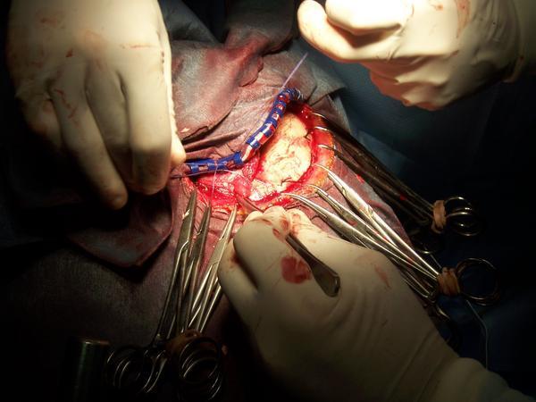 bellalaghostie:  mediclopedia:   Craniotomy One of the most common neurosurgical