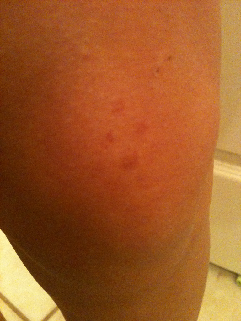 You can&rsquo;t really tell, but I have little bruises from the barricade. And