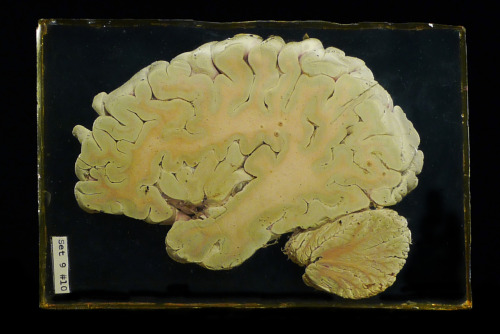 ryanmatthewcohn:  A Section of a Human Brain Preserved in Lucite. Ryan Matthew’s Collection. Photo by Sergio Royzen. 