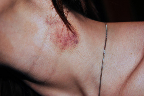 hickey