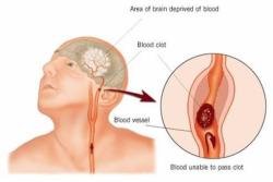 Haetae:  Stroke Identification: A Neurologist Says That If He Can Get To  A Stroke