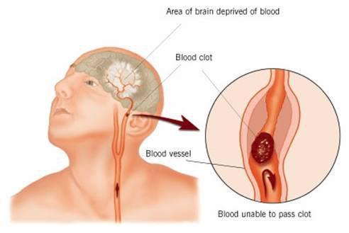 Porn haetae:  STROKE IDENTIFICATION: A neurologist photos