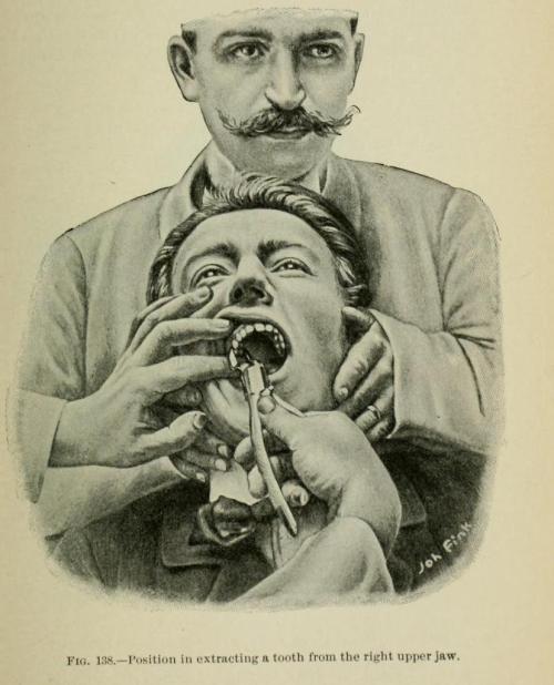 biomedicalephemera:Position in extracting a tooth from the right upper jaw.Fun with dentistry!There 