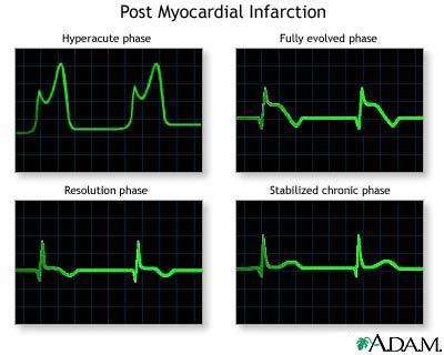 rambling-medic:  How do doctors look at ECGs and determine a patient has had a heart