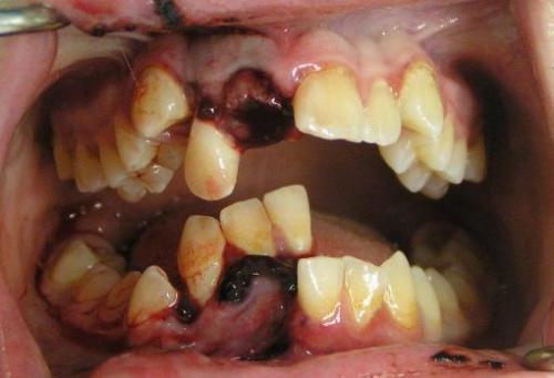 deformutilation:  Dental trauma affecting the right incisors and lower canine with avulsion of the upper right central dento-aveolar fracture containing the lower right incisors and canines. 