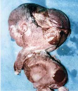 onceiwasanembryo:  Extreme hydrocephalus;