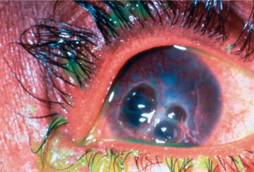 deformutilation:  A thinned cornea and protruding Descemet’s membrane(the inner corneal layer) 