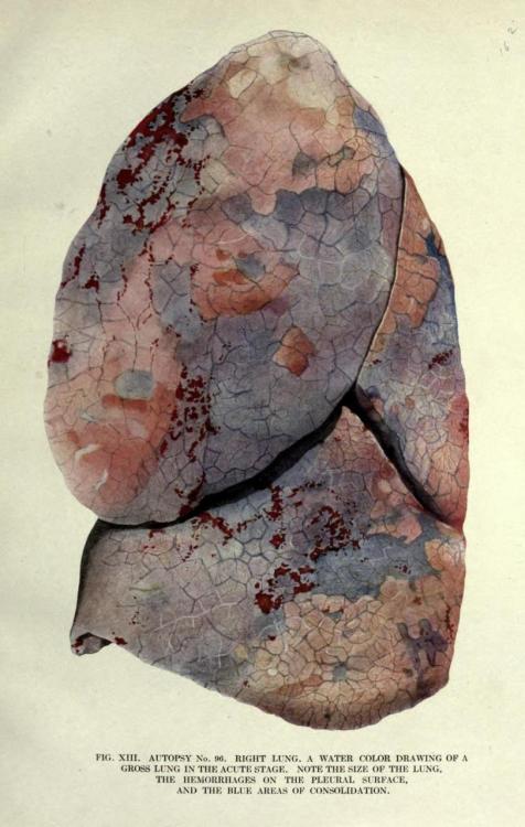 biomedicalephemera: Right lung with surface hemorrhages Lung moderately enlarged due to influenza. N