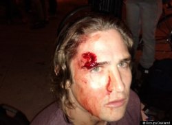 stfuconservatives:  Via Occupy Oakland’s Twitter account, an image of a protester struck by a rubber bullet fired by police: 