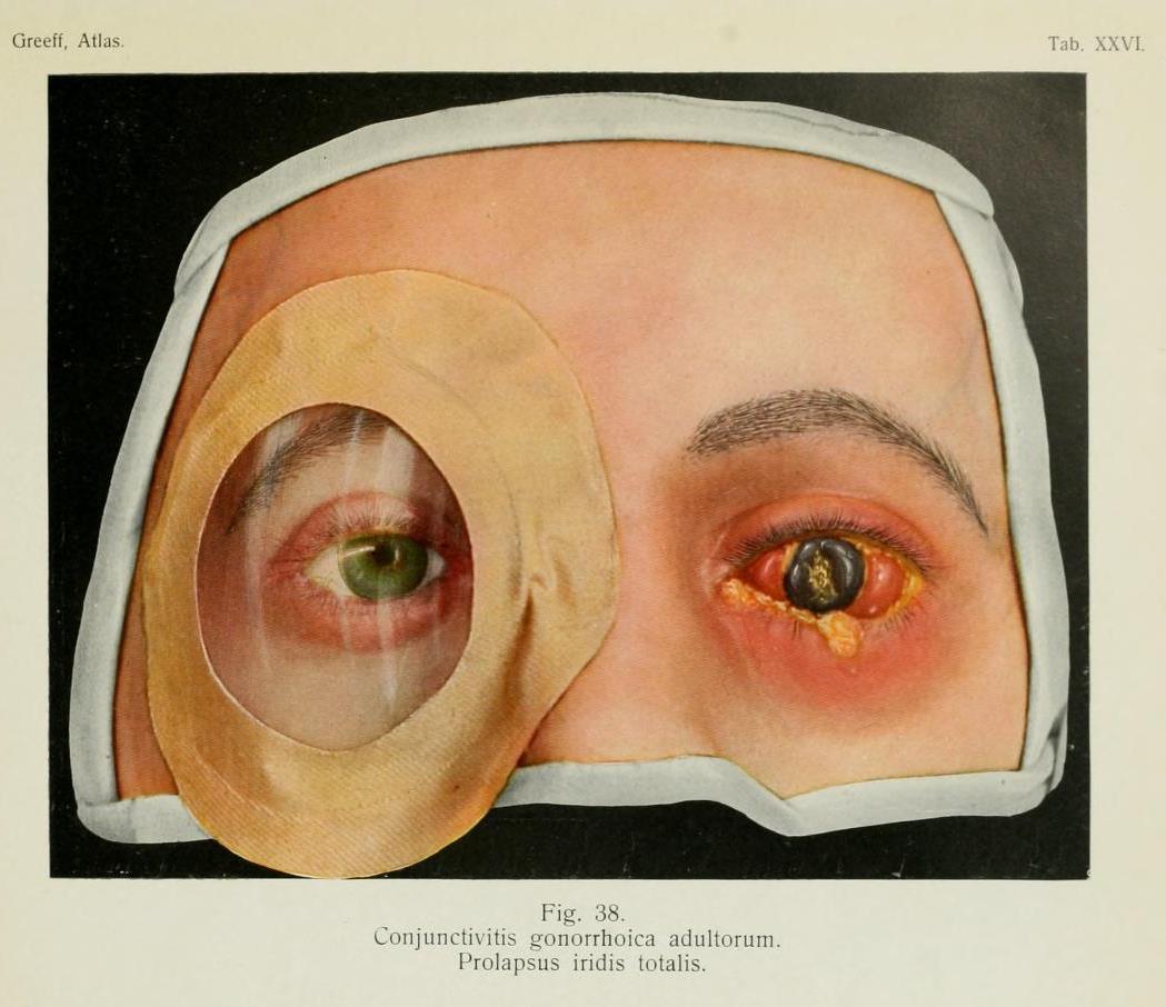 Conjunctivitis gonorrhoica adultorum
Gonorrhea can cause pose a risk to the newborn infant quite easily, especially when it’s contracted during childbirth and not caught until the eye is significantly pustular and weeping, but when gonorrheal...