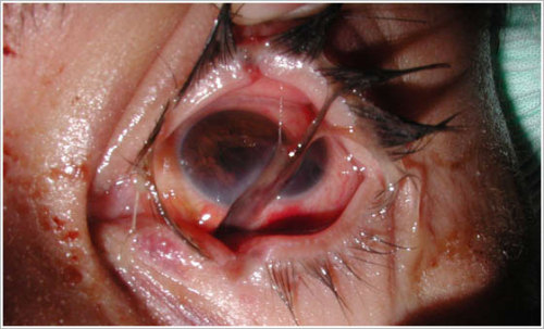 eyedefects:Ocular Trauma 