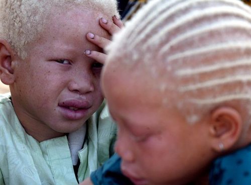 Albino african children. Senegal, Africa. 