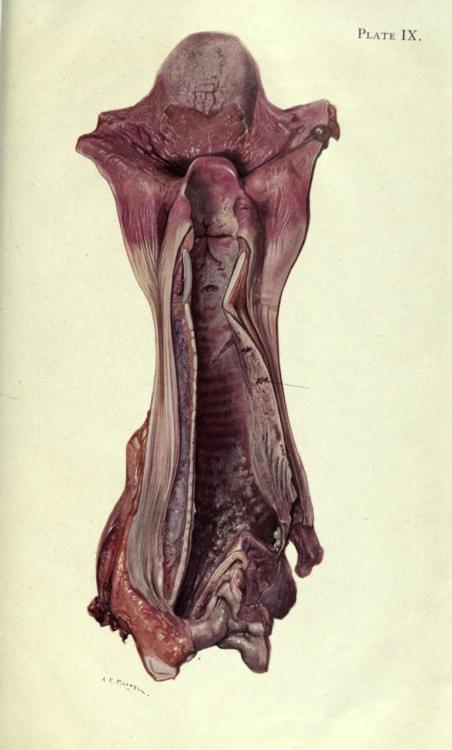 Ulceration of the trachea by mustard gas.
When the mucous membrane of the trachea and bronchi is exposed to mustard gas, it reacts much the same way as the skin, with intense inflammation followed by sloughing of the necrotic tissue. The dead...