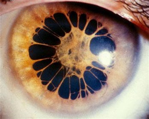 deformutilations:  Accessory iris membrane is a rare congenital anomaly resulting from hyperplasia of the superficial layer of the iris. It presents as an additional layer of iris tissue giving the impression that the iris is duplicated. 
