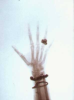 ohsoromanov:   X-rays of the Hand and Wrist of Nicholas II, Emperor of Russia, and Alexandra, Empres