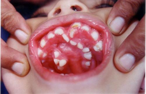 uglyuglyugly:  Hyperdontia is the condition of having supernumerary teeth, or teeth which appear in addition to the regular number of teeth. 