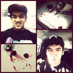 💢 2stitches and lots of blood hahaha.  (Taken with instagram)