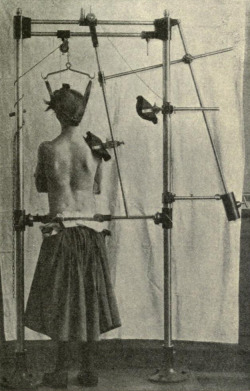 muscavomitoria:  Apparatus designed by Schulthess to raise the right shoulder, from Alfred Tubby’s Deformities, including diseases of the bones and joints, 1912 