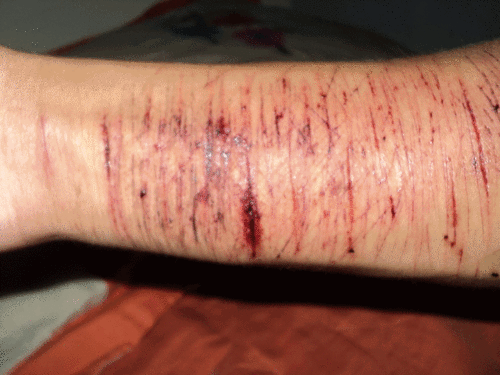 sangue-e-cicatrizes:  Cortes que sangram, feridas profundas, machucados que jamais