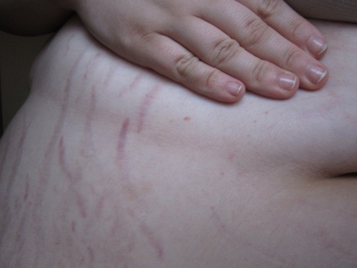 unknowablewoman:  This is, quite simply, a stretch mark appreciation post.  