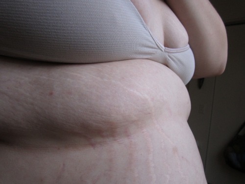 unknowablewoman:  This is, quite simply, a stretch mark appreciation post.  