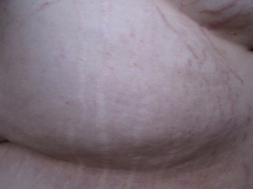 unknowablewoman:  This is, quite simply, a stretch mark appreciation post.  