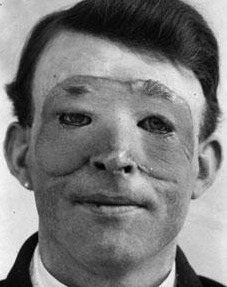 worms-fear-god-god-fears-youth: mspaintadventuring:  tranimation:   Patients of surgeon Harold Gillies during WWI and WWII  Okay, these photographs pissed me off a bit, because they don’t show off how much of a genius Dr. Harold Gillies, the father
