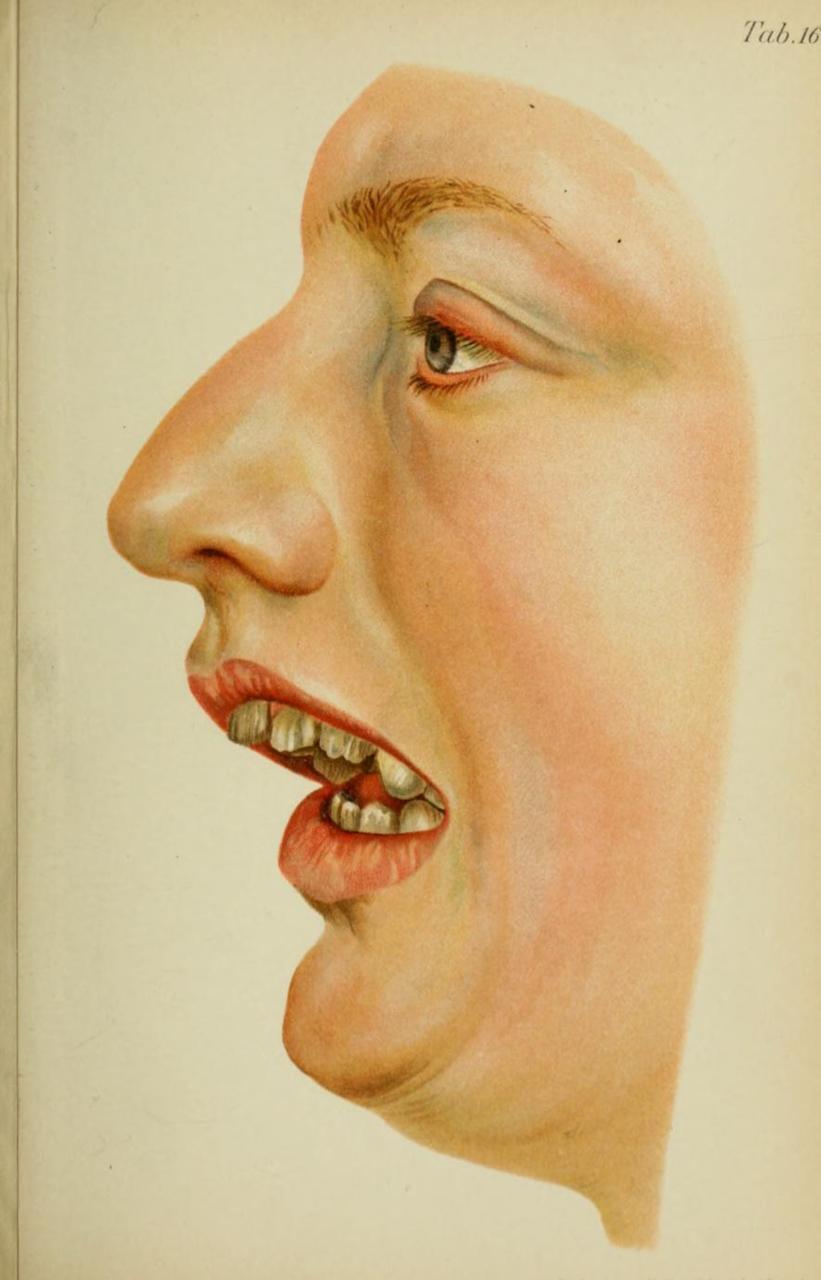 Habsburg jaw: mandibular prognathism