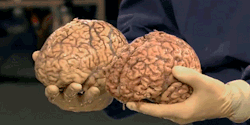 milesian:  A healthy human brain (left) compared to the brain of a 90 year old (right) which is only two thirds the size of the young brain. Over time, white matter decreases and the brain shrinks. This gradual shrinkage is most extreme between age 70