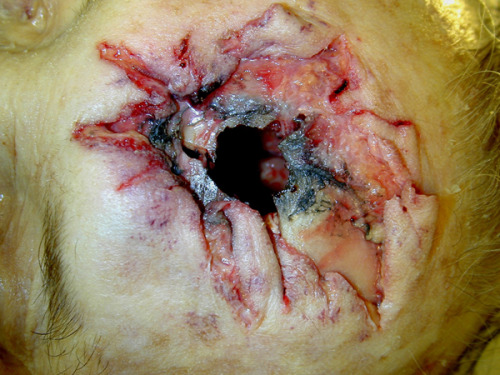 fuckyeahforensics:  Stellate hard contact wound of the head. Note the abundant soot in the wound depths. 