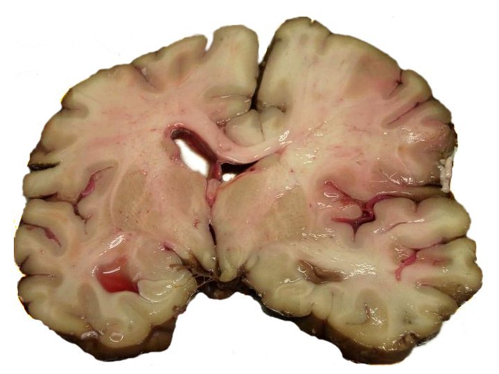forensicpathologist:  A slice of brain from the autopsy of a person who suffered