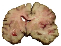 forensicpathologist:  A slice of brain from the autopsy of a person who suffered an acute middle cerebral artery (MCA) stroke 