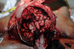forensicsandpathology:  Subdural hemorrhage