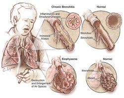 nursing4n00bs:  YOUR WEEKEND NCLEX TIP  Chronic is more stable than acute. This gets tricky when you’re trying to prioritize your care and there’s a chronically ill patient involved. For example, even though COPD is an airway issue, it’s a chronic