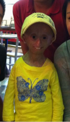 thewolf-inme:  aimez-vous:  Today, I met a very special girl. I was at the mall with my brother shopping and while we were at the food court, we saw this little girl. Her name is Hana. She is THE ONLY person in California who is diagnosed with Progeria.