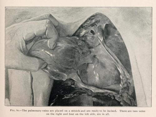 biomedicalephemera:Proper technique for removal of the heart from the body.The heart should be grasp