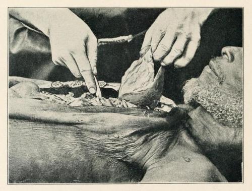 biomedicalephemera:Proper technique for removal of the heart from the body.The heart should be grasp