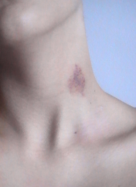 acidnationn:  God i love my hickey. I think it’s the best one yet. 