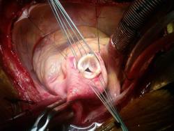 medicalschool:  Open heart surgery for valve