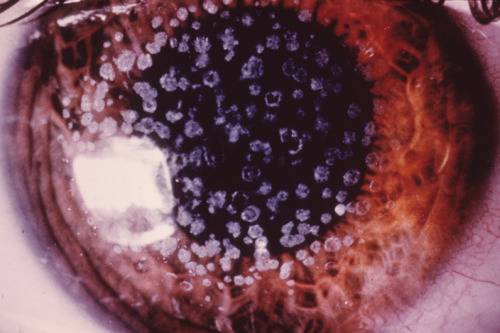 eyedefects:Cornea with granular dystrophy.