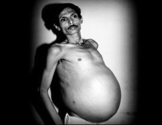 sly-nig:  supremepeniskingsam:  skinned-teen:  Sanju Bhagat’s stomach was once