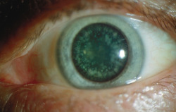 eyedefects:  Congenital cortical cataract 