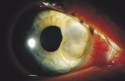 eyedefects:  Iris cyst 