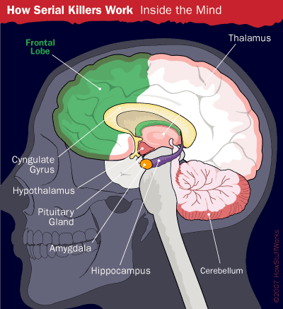 criminalprofiler:  Brain Injury and Serial Murder Some researchers theorize that