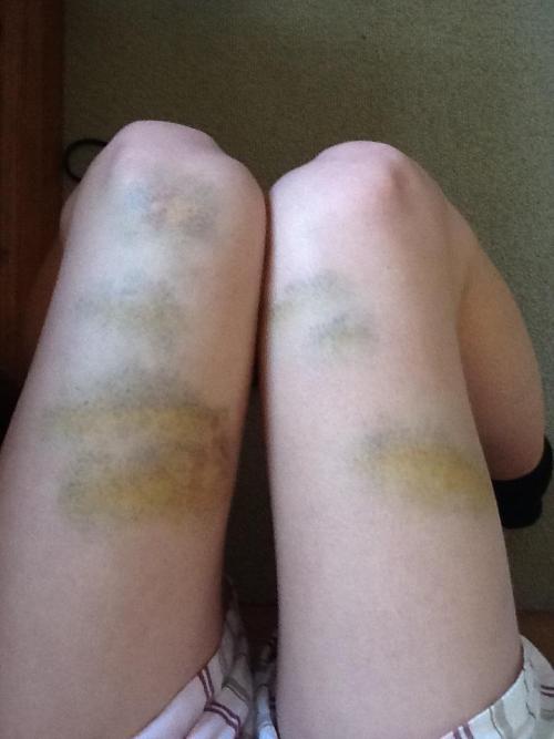 subtleprettythings:  Schoolies bruises. 